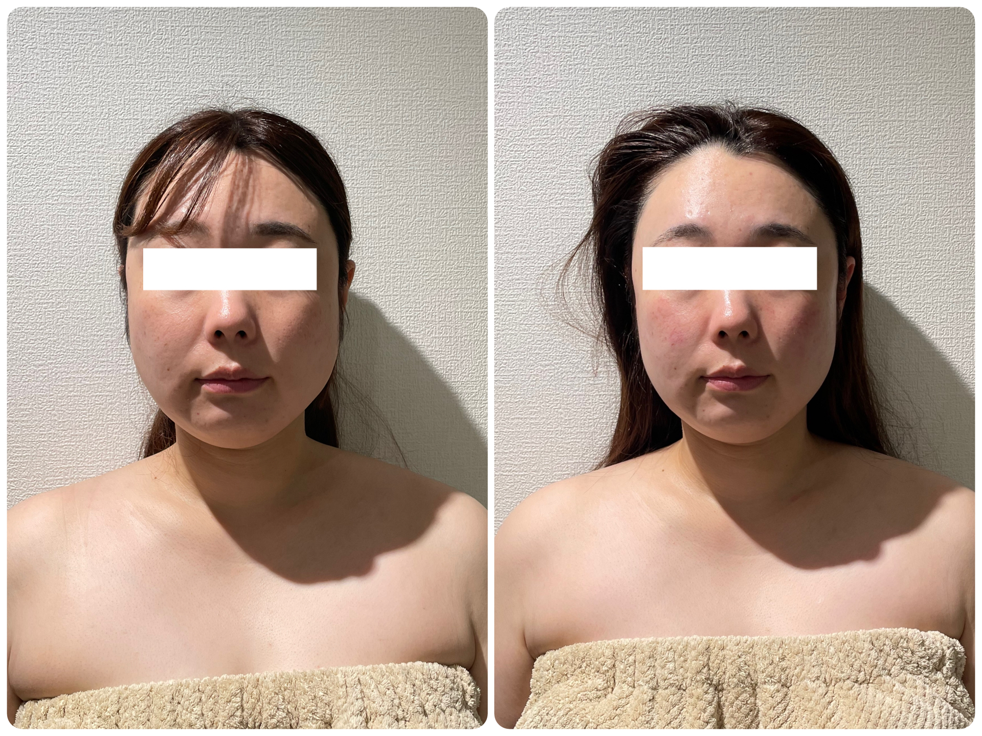 小顔エステのビフォーアフター事例